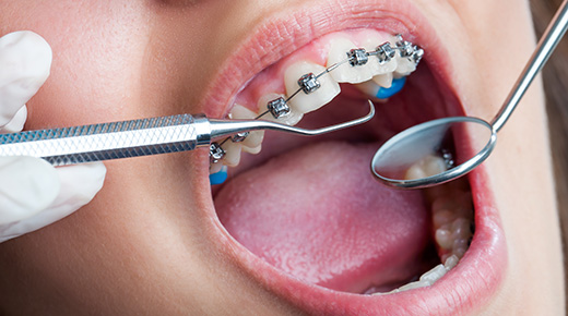Kimler İçin Ortodonti